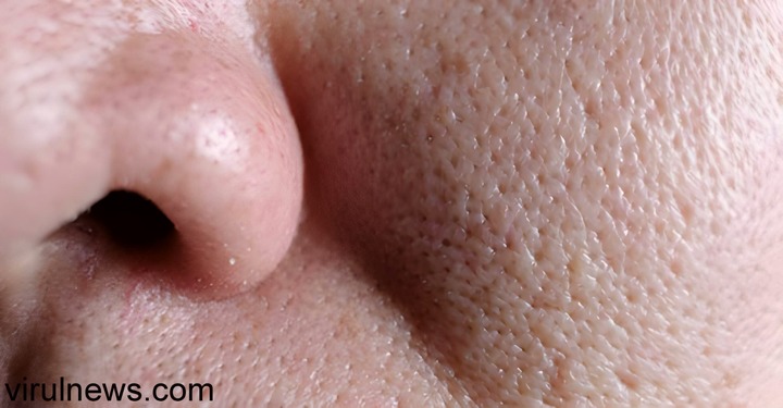 How to minimize enlarged pores?