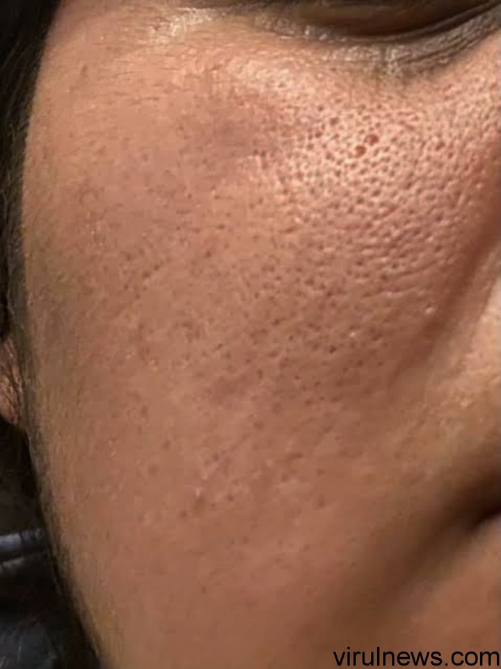 Ways to get rid of open pores in a short time