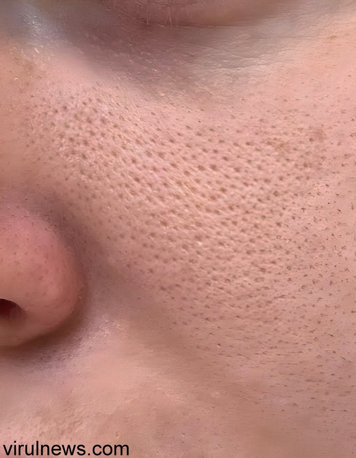 get rid of open pores after age 20 