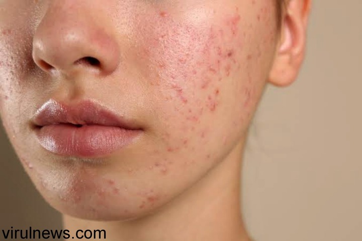 instant relief from acne in teen age