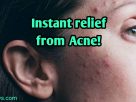 instant relief from acne!