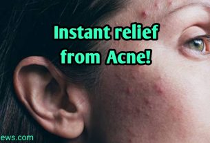 instant relief from acne!