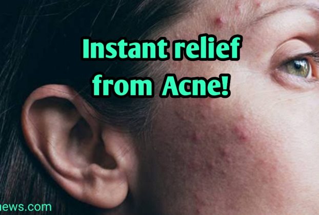 instant relief from acne!