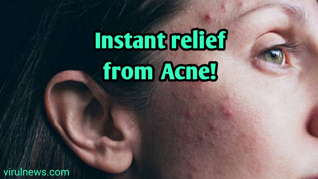 instant relief from acne!