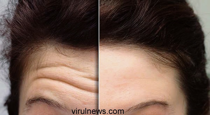 How to prevent forehead wrinkles